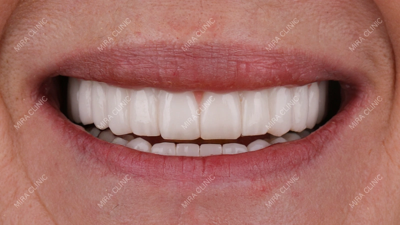 Full Mouth Dental Implants